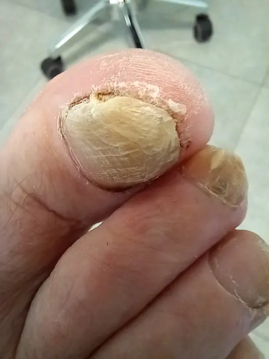 Vyčistenie a odľahčenie poškodeného nechtu