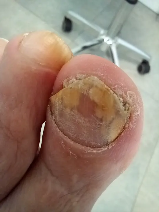 Vyčistenie a odľahčenie poškodeného nechtu