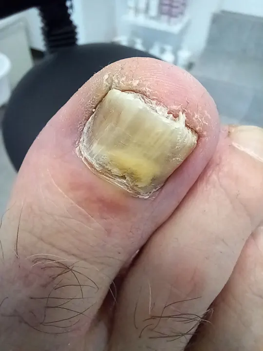 Ošetrenie výrazne zmeneného nechtu