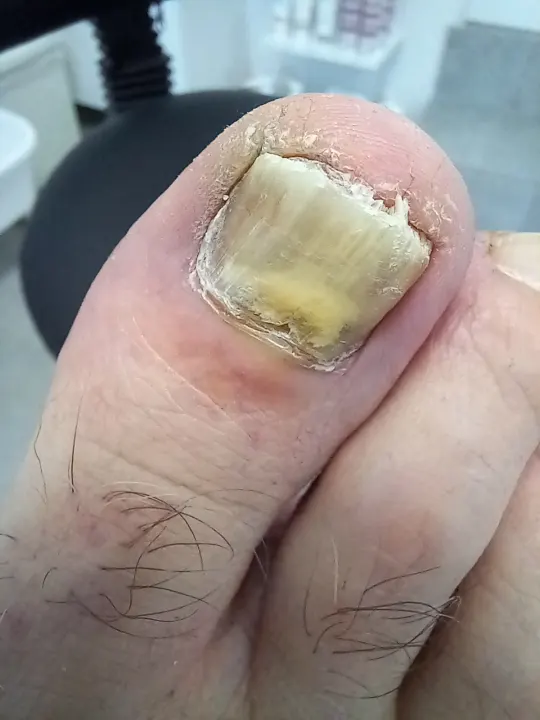 Ošetrenie výrazne zmeneného nechtu