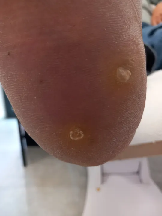 Komplexné ošetrenie chodidla s tlakovými miestami