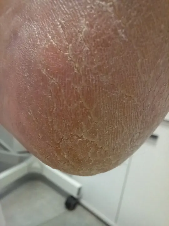 Postupné ošetrenie výrazne zrohovatenej päty
