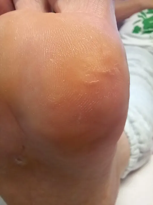 Ošetrenie viacerých tlakových miest na chodidle