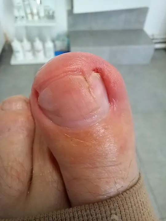 Ošetrenie poškodeného nechtu a jeho okolia