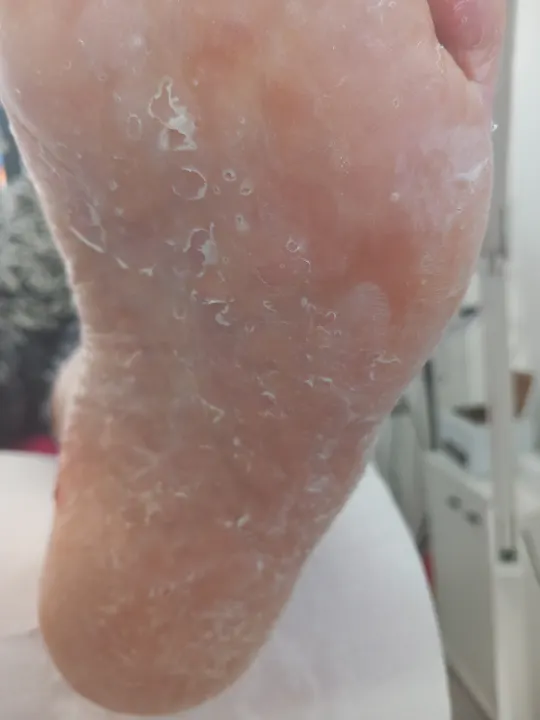Vyhladenie silno zhrubnutej kože na päte