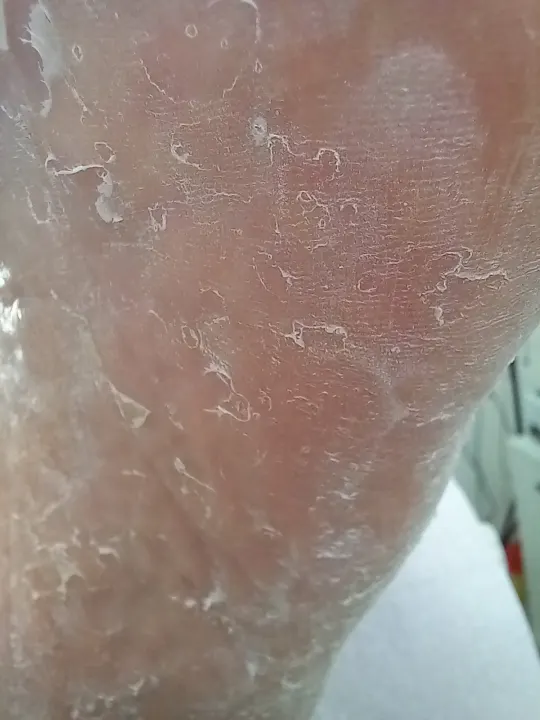 Vyhladenie silno zhrubnutej kože na päte