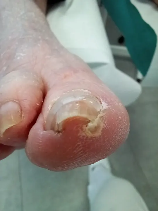 Šetrné vyčistenie poškodeného nechtu