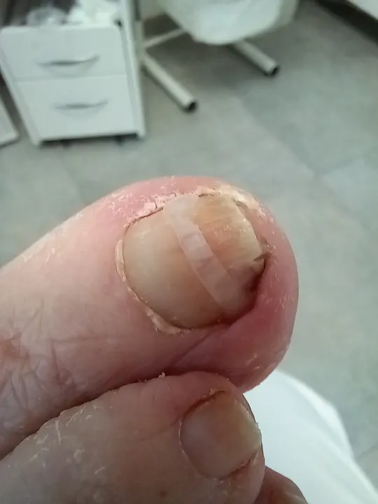 Šetrné vyčistenie poškodeného nechtu
