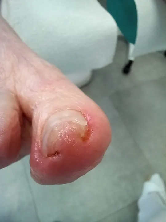 Šetrné vyčistenie poškodeného nechtu