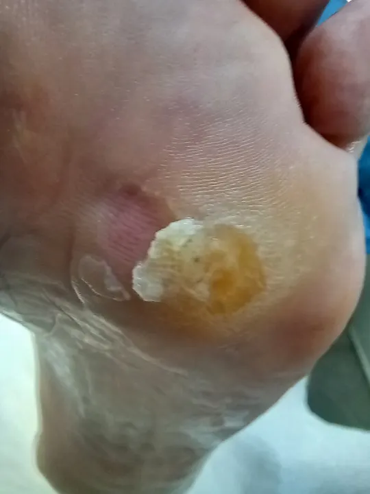 Ošetrenie viacerých tlakových ložísk na chodidle
