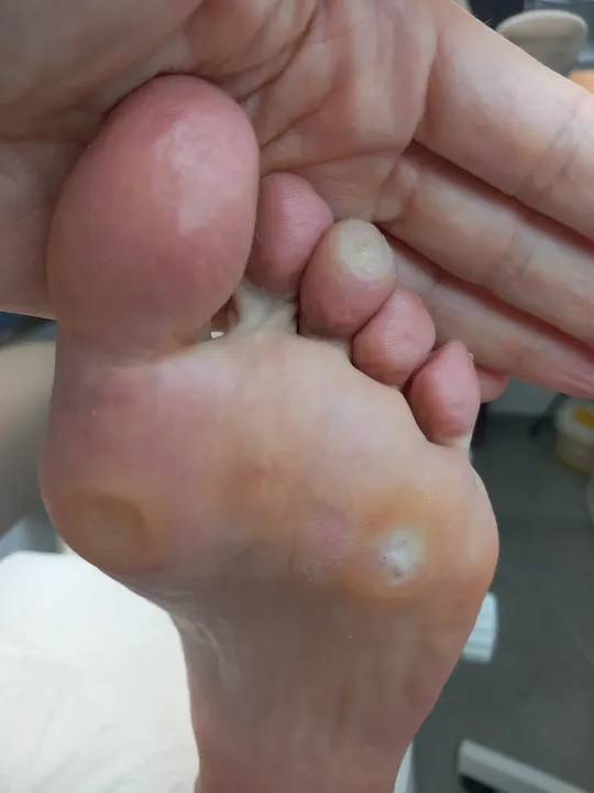 Ošetrenie viacerých tlakových ložísk na chodidle