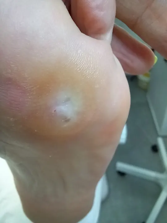 Ošetrenie viacerých tlakových ložísk na chodidle