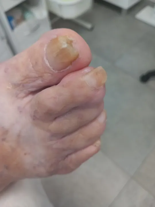 Úprava zhrubnutého nechtu palca