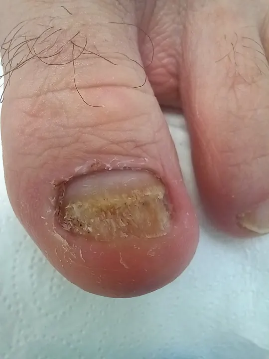 Rekonštrukcia poškodeného nechtu palca