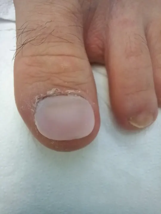 Rekonštrukcia poškodeného nechtu palca