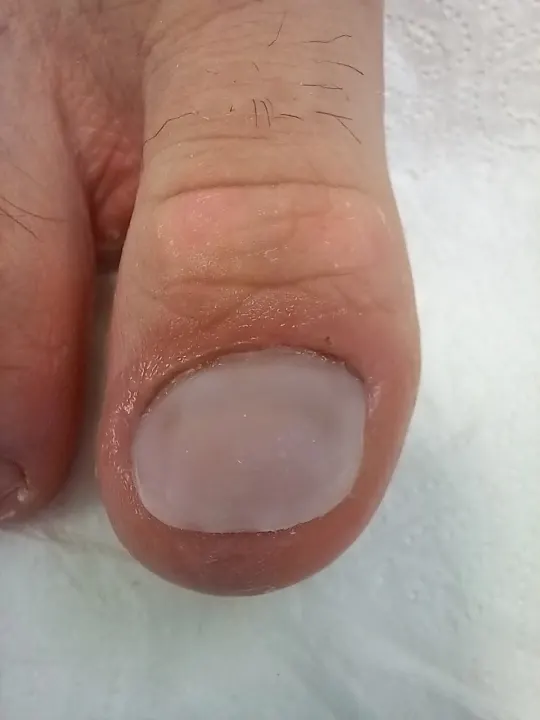 Rekonštrukcia poškodeného nechtu palca