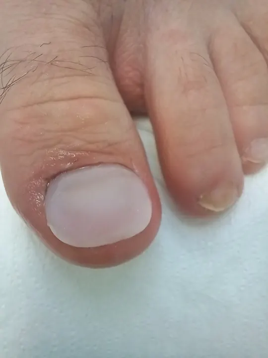 Rekonštrukcia poškodeného nechtu palca