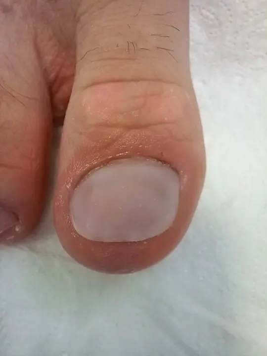 Rekonštrukcia poškodeného nechtu palca